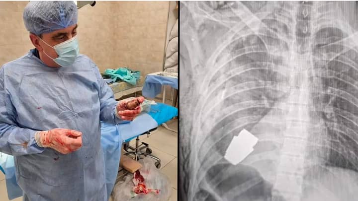 Surgeons remove unexploded grenade lodged in Ukrainian soldier’s chest